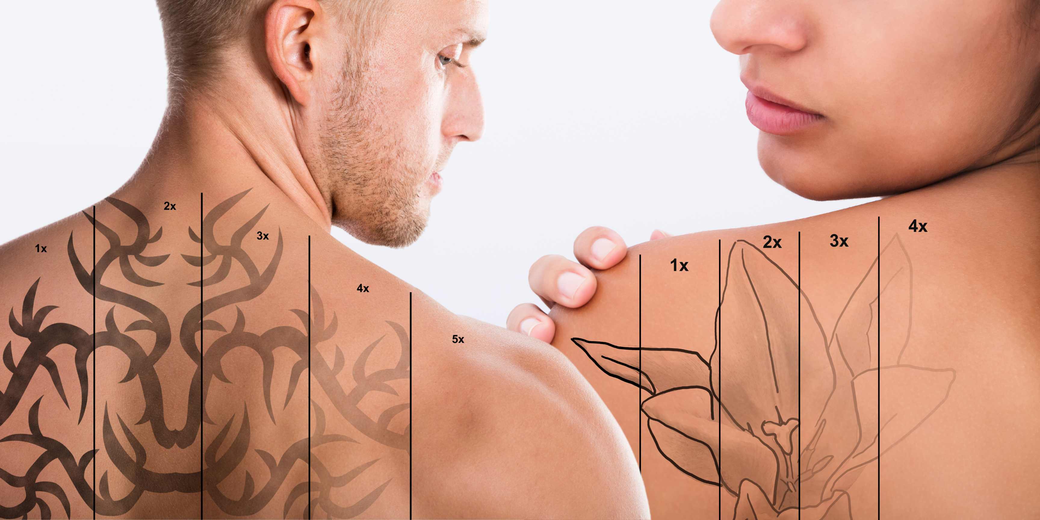 Precision Laser Tattoo Removal - 